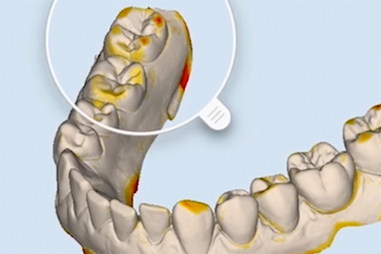 Scanner 3D intraoral - iTero® Element™ - Align Technology - para ortodontia  / para odontologia